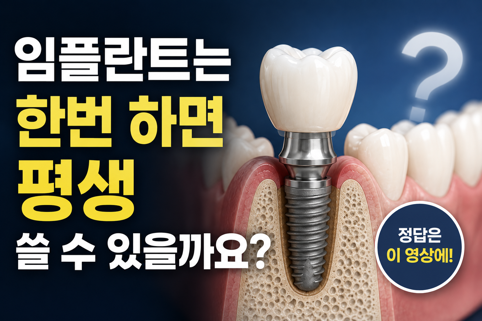 임플란트는 한번 하면 평생 쓸 수 있을까요?