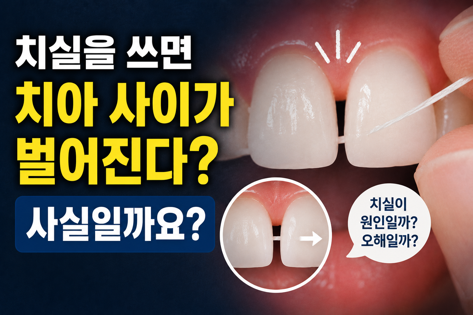 치실을 쓰면 치아 사이가 벌어진다는 말, 사실일까요?