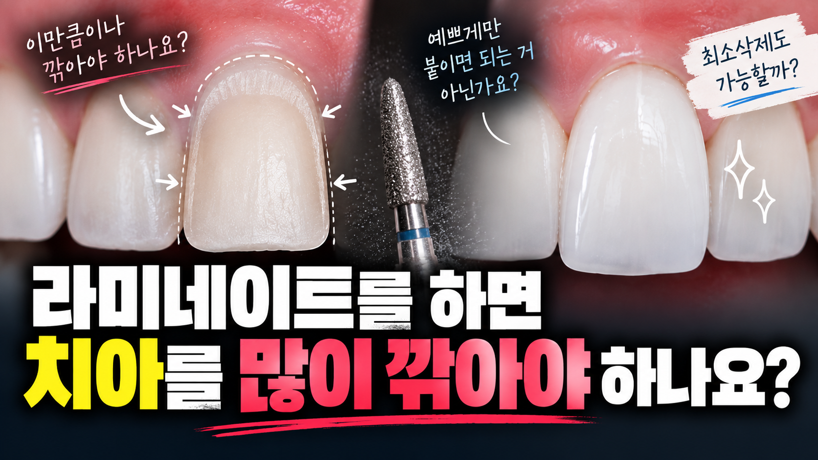 라미네이트를 하면 치아를 많이 깎아야 하나요?