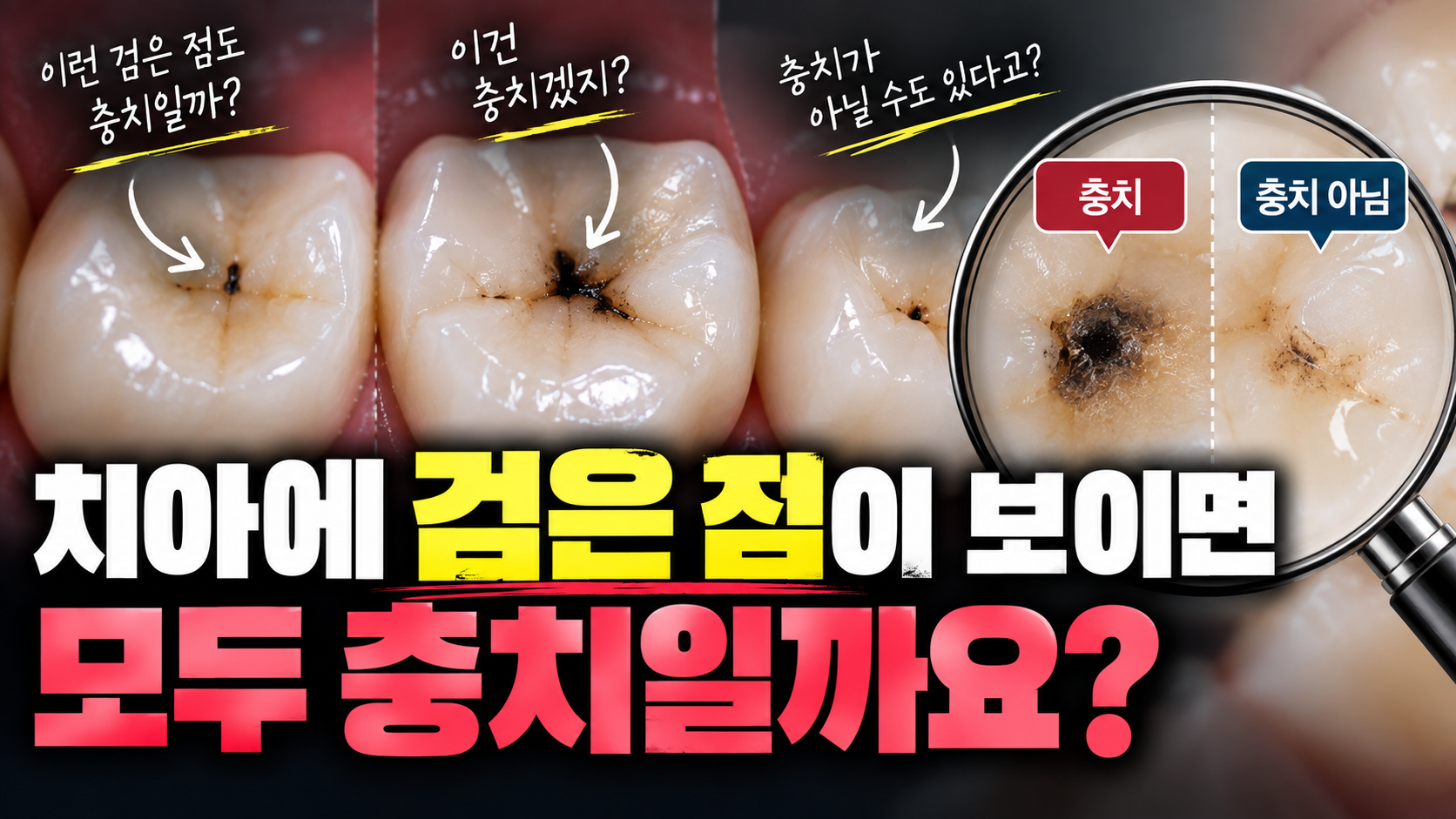 치아에 검은 점이 보이면 모두 충치일까요?