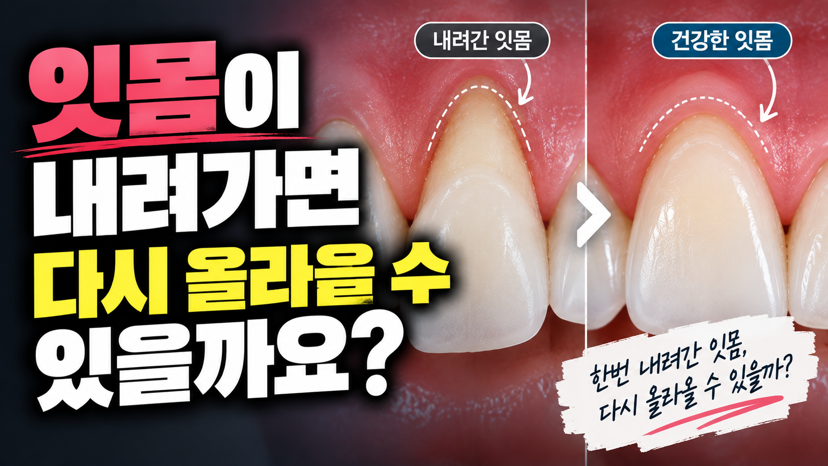 잇몸이 내려가면 다시 올라올 수 있을까요?