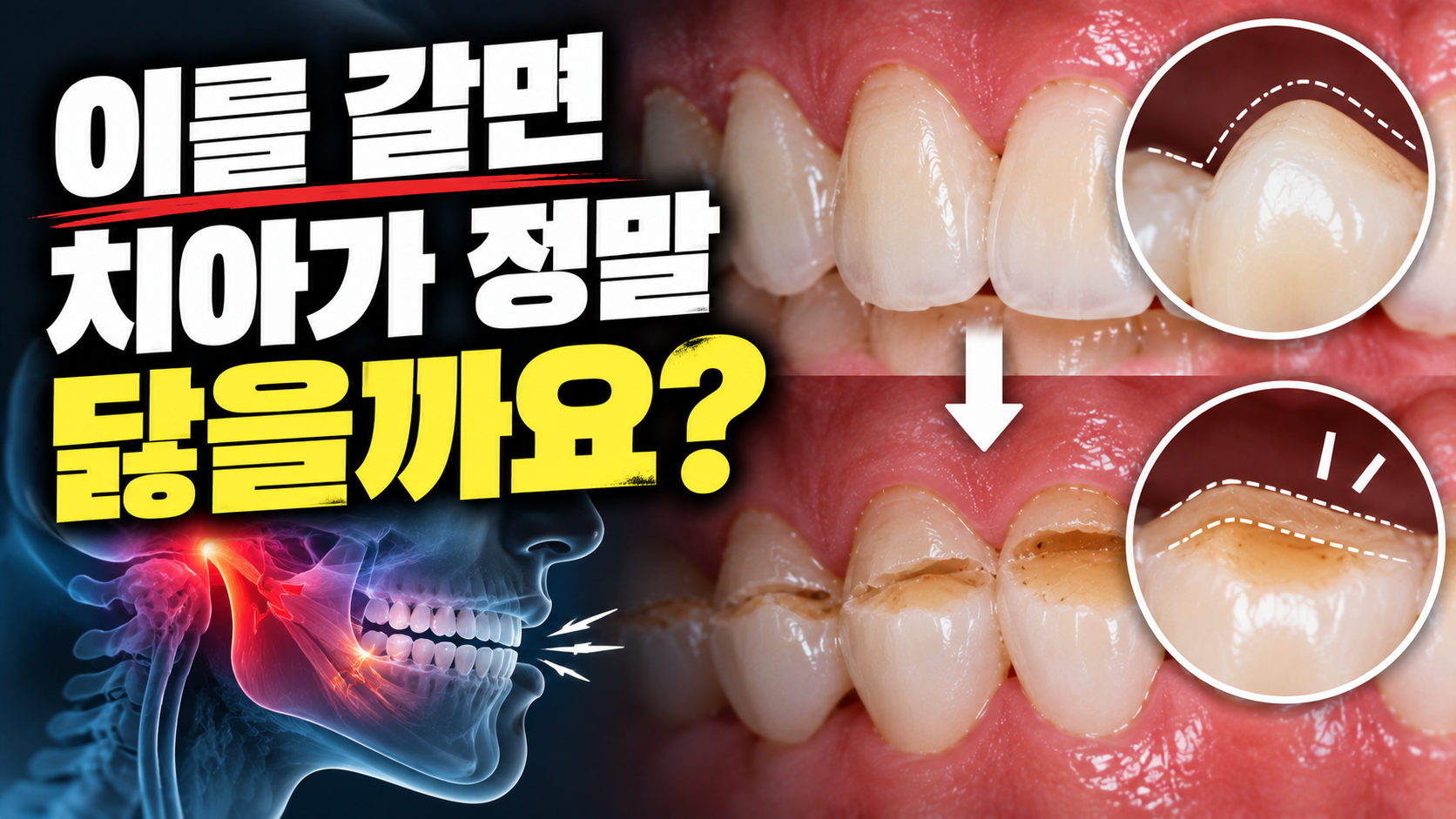 이를 갈면 치아가 정말 닳을까요