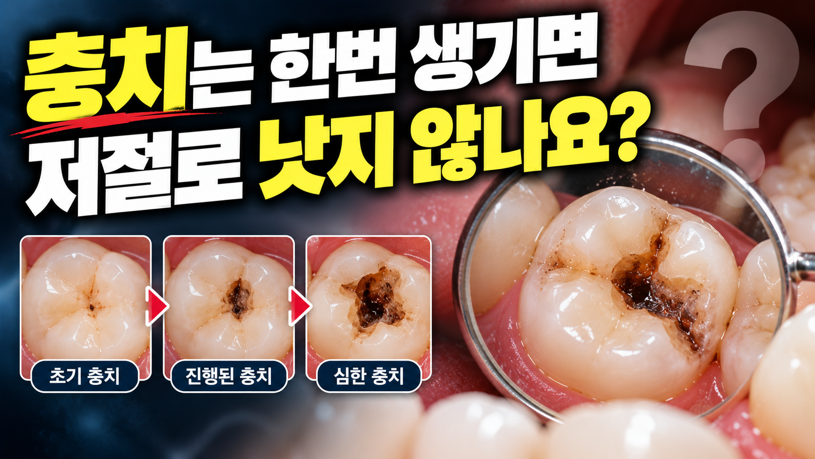 충치는 한번 생기면 저절로 낫지 않나요