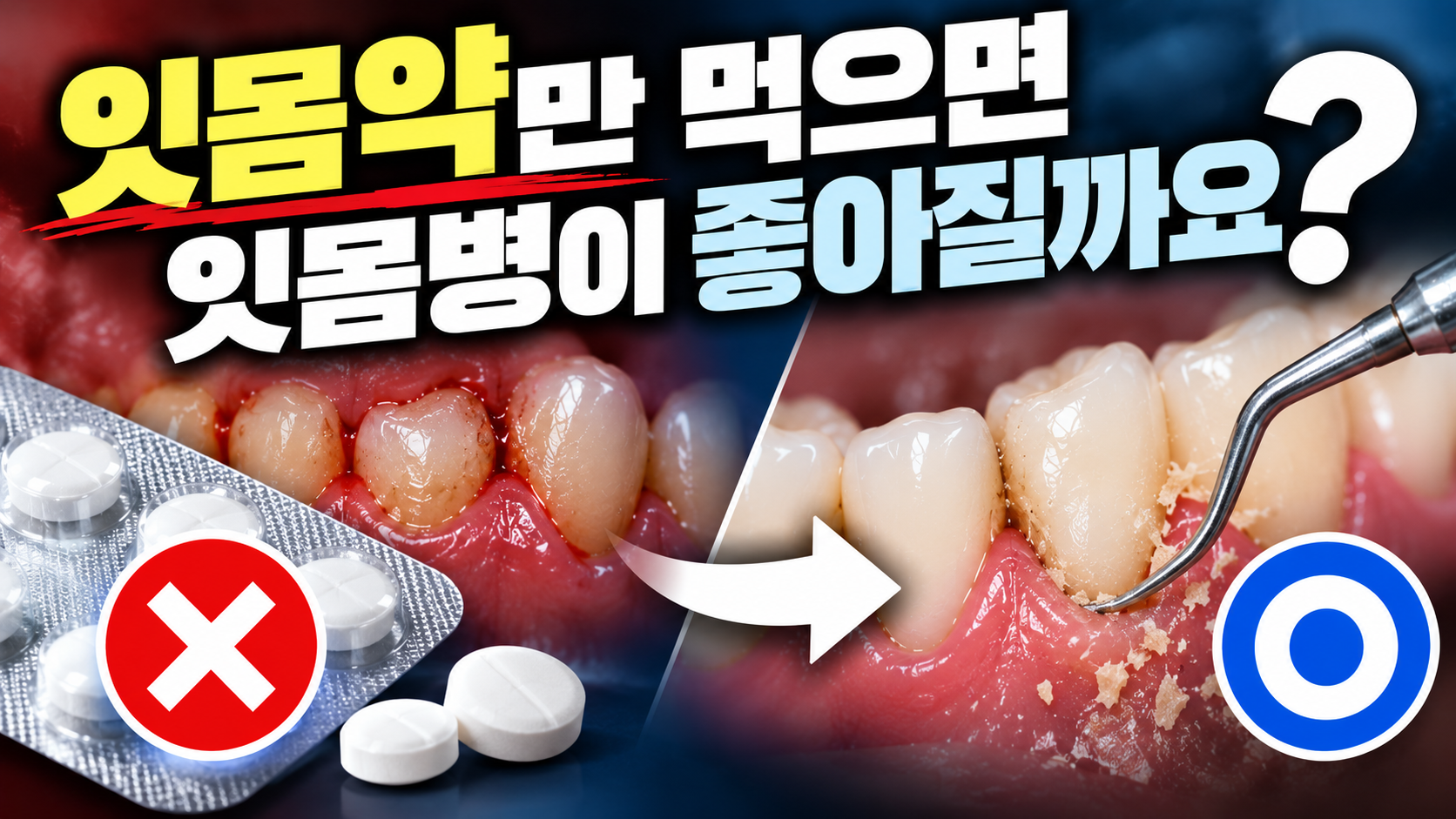 잇몸약만 먹으면 잇몸병이 좋아질까요?