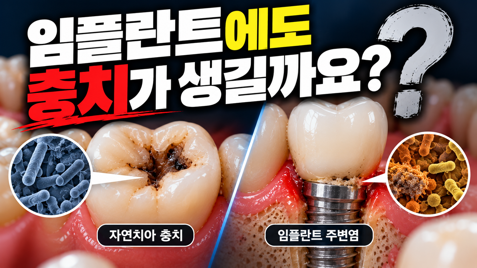 임플란트에도 충치가 생길까요?