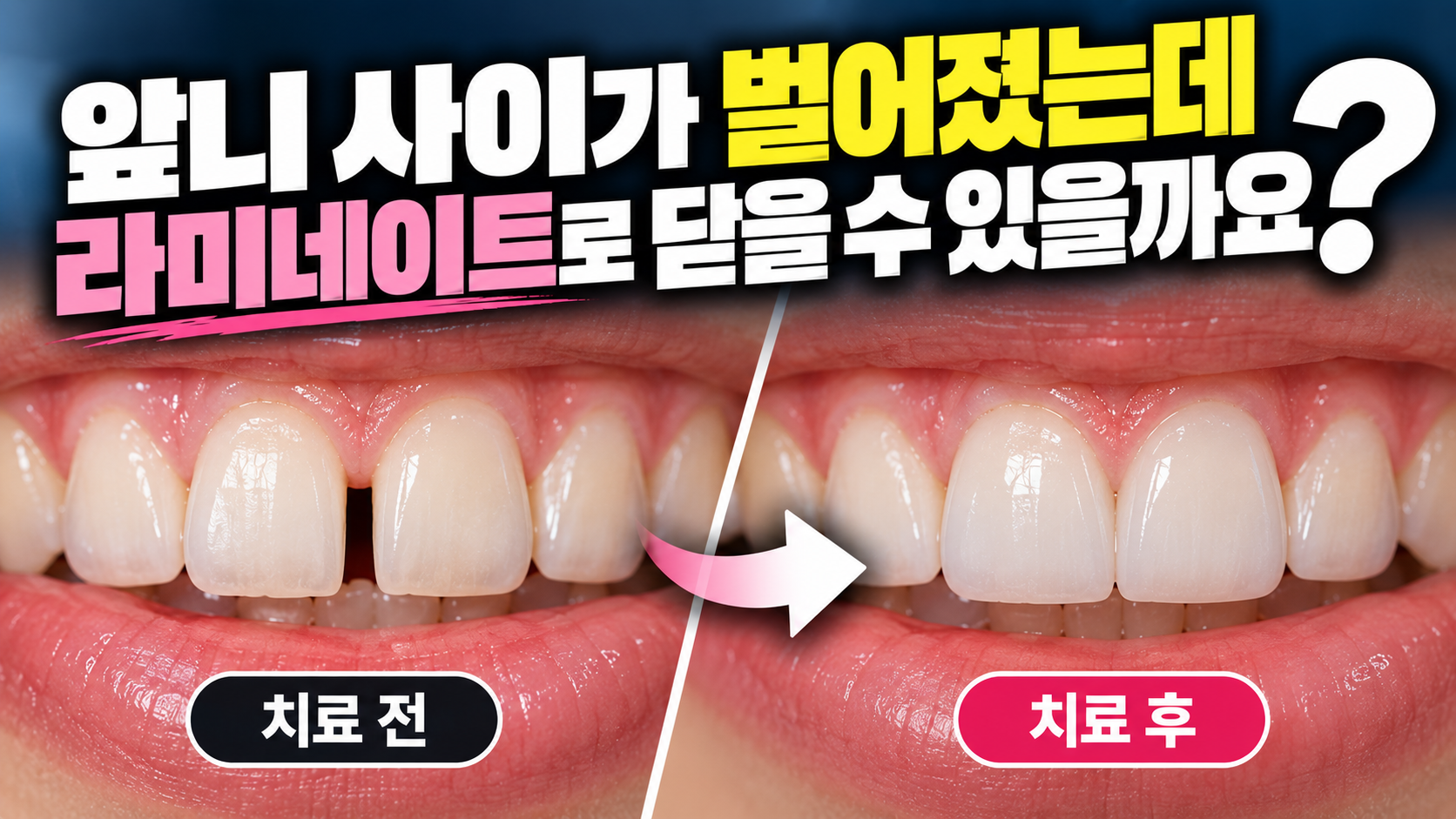 앞니 사이가 벌어졌는데 라미네이트로 닫을 수 있을까요?