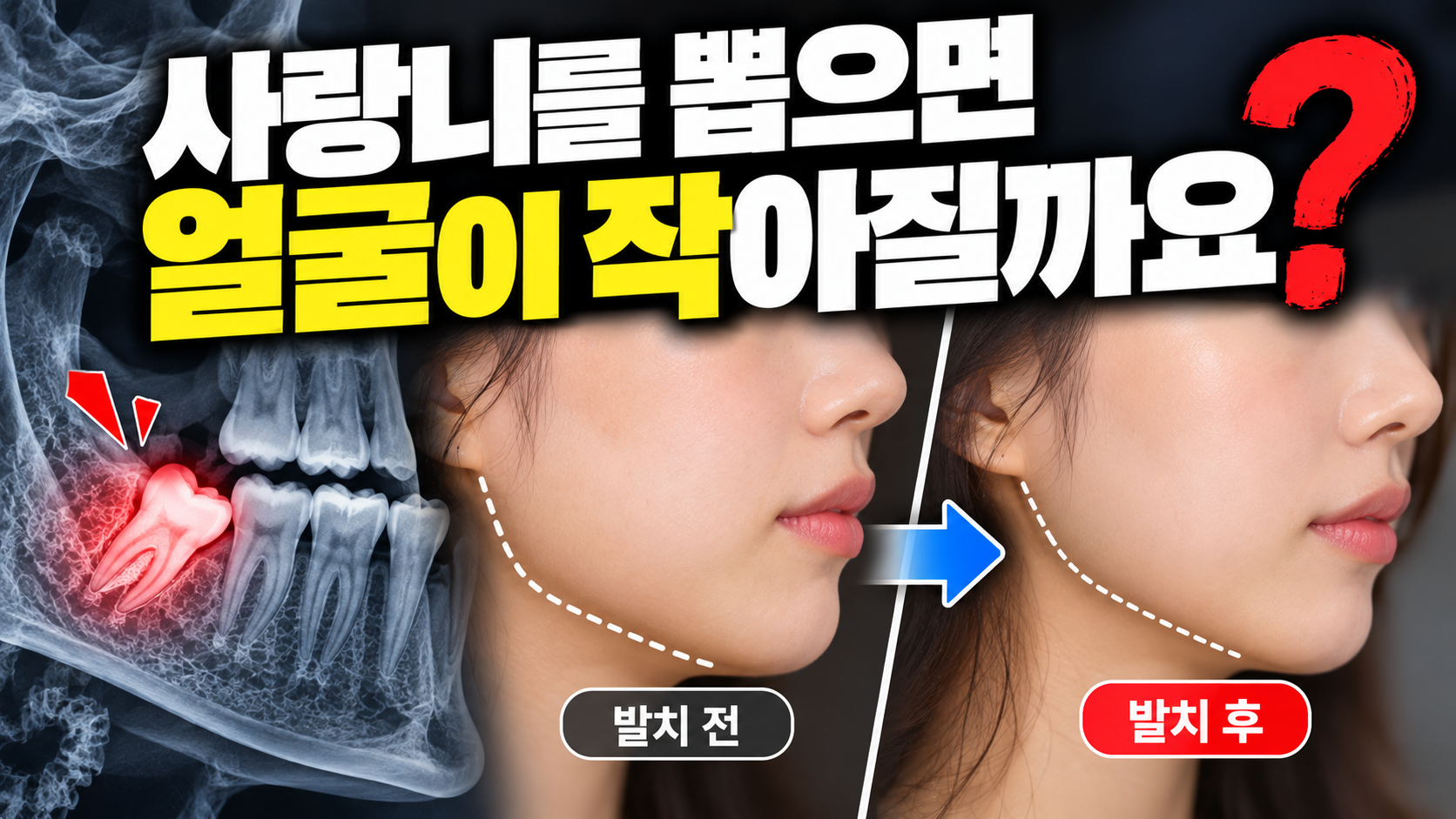 사랑니를 뽑으면 얼굴이 작아질까요?