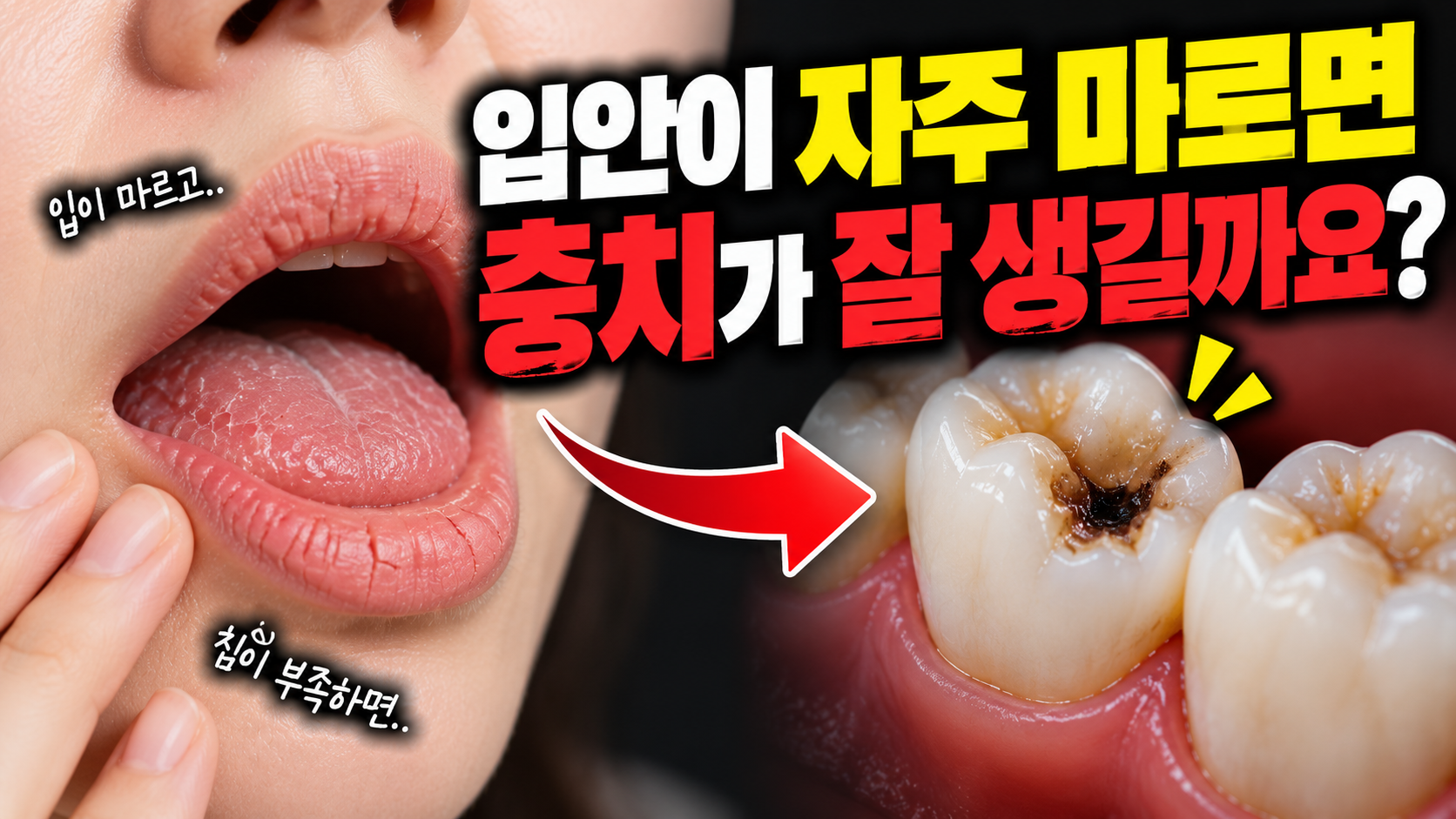 입안이 자주 마르면 충치가 잘 생길까요?