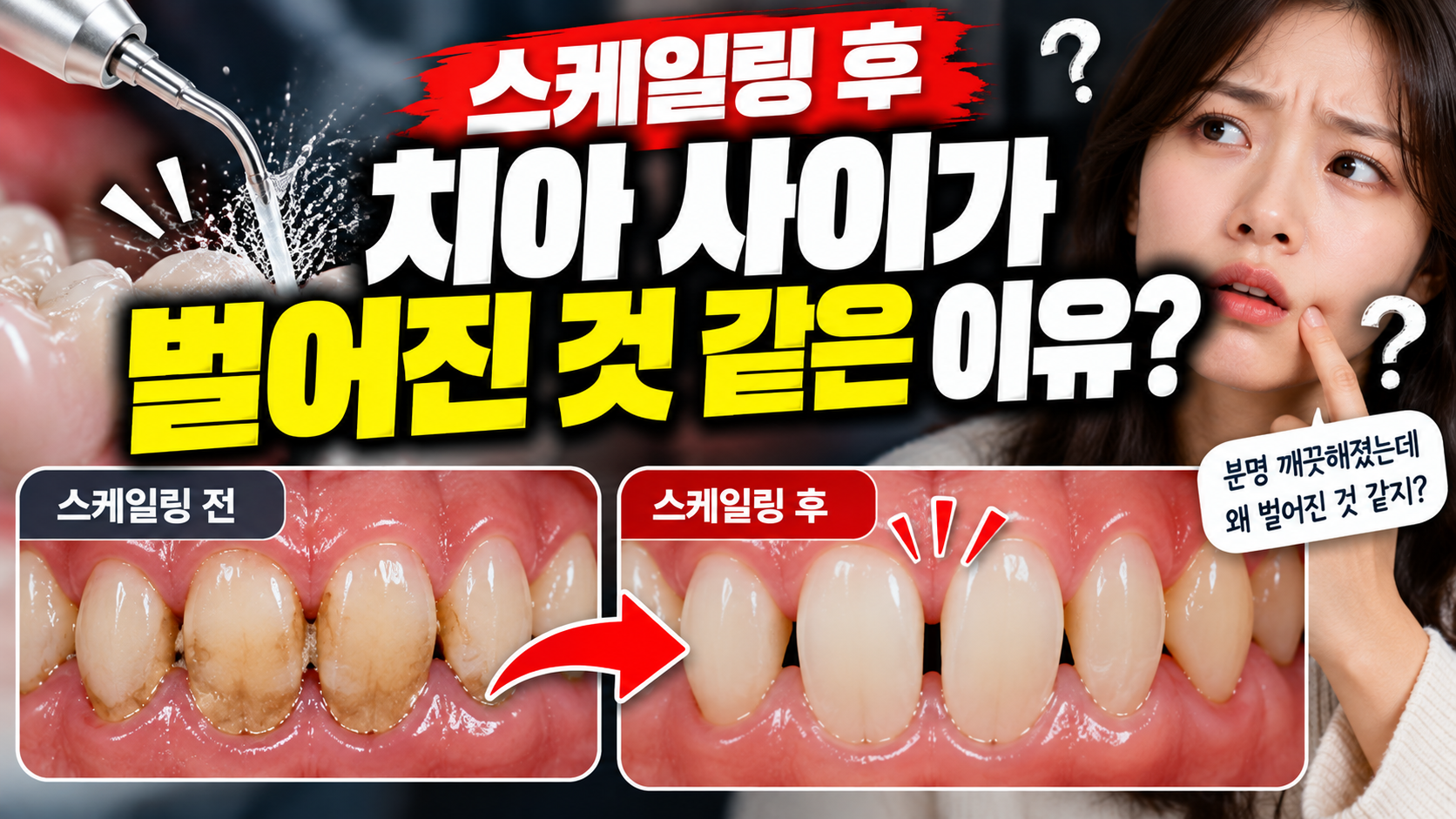 스케일링 후 치아 사이가 벌어진 것 같은 이유