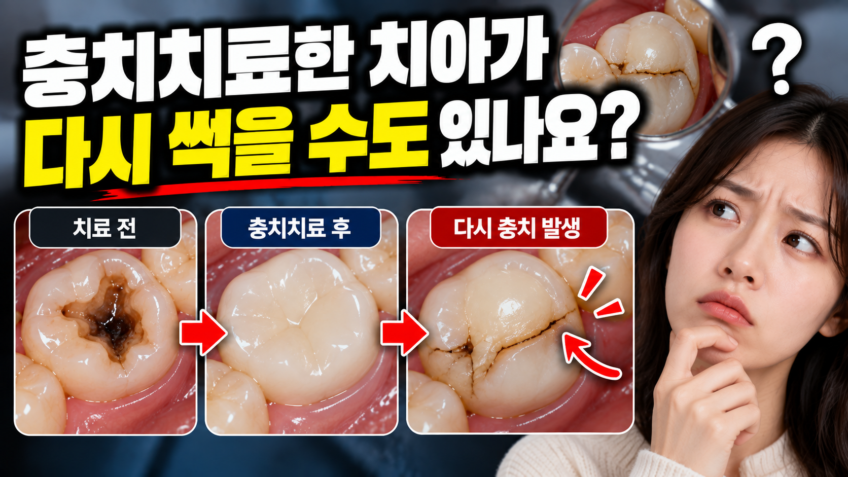 충치치료한 치아가 다시 썩을 수도 있나요?