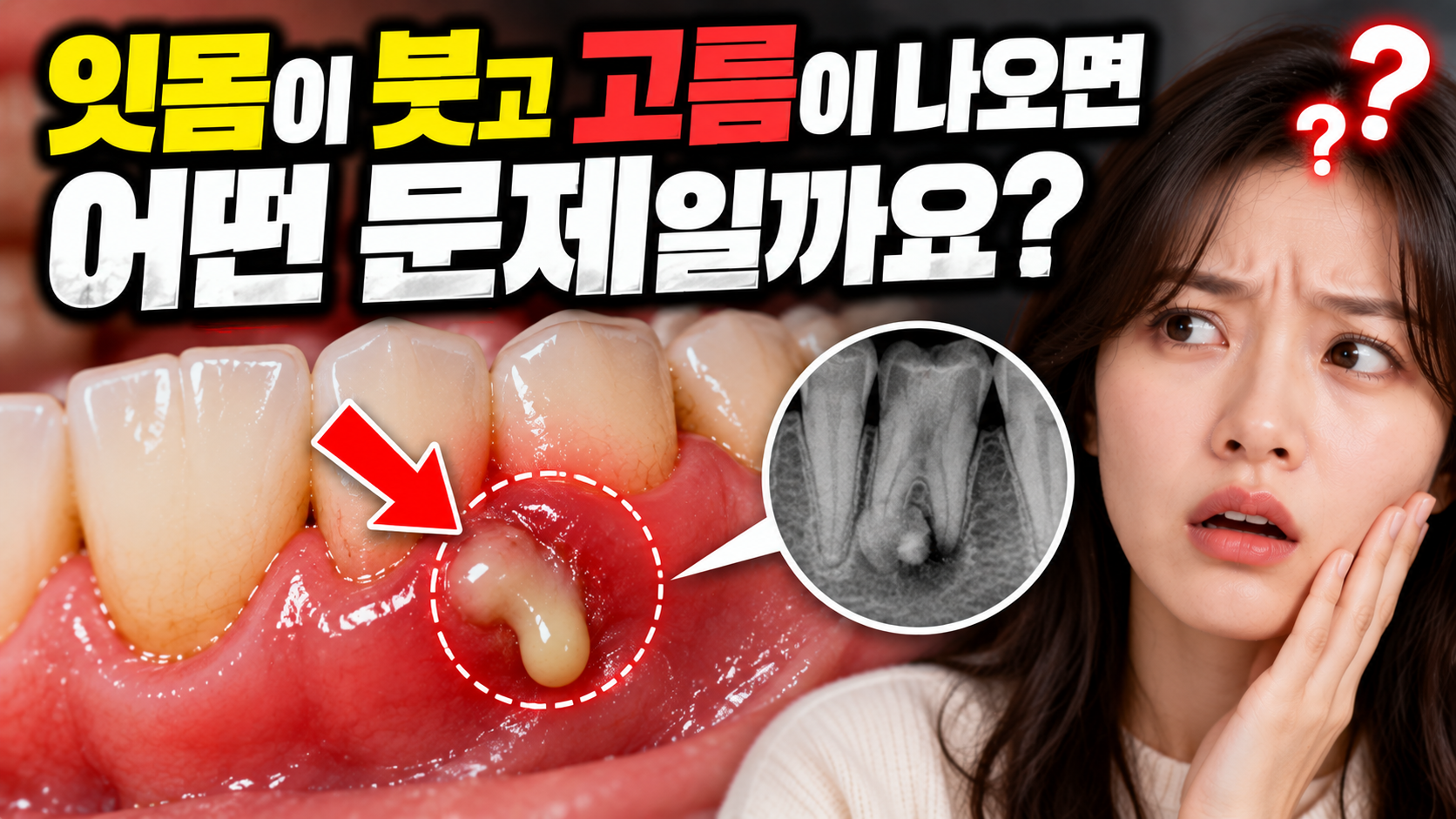잇몸이 붓고 고름이 나오면 어떤 문제일까요?