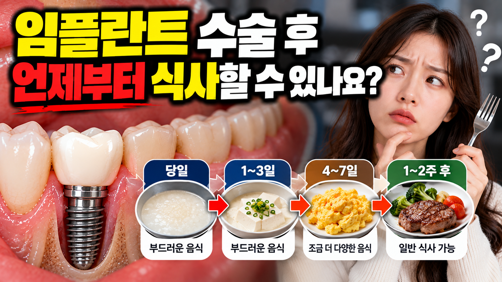 임플란트 수술 후 언제부터 식사할 수 있나요?