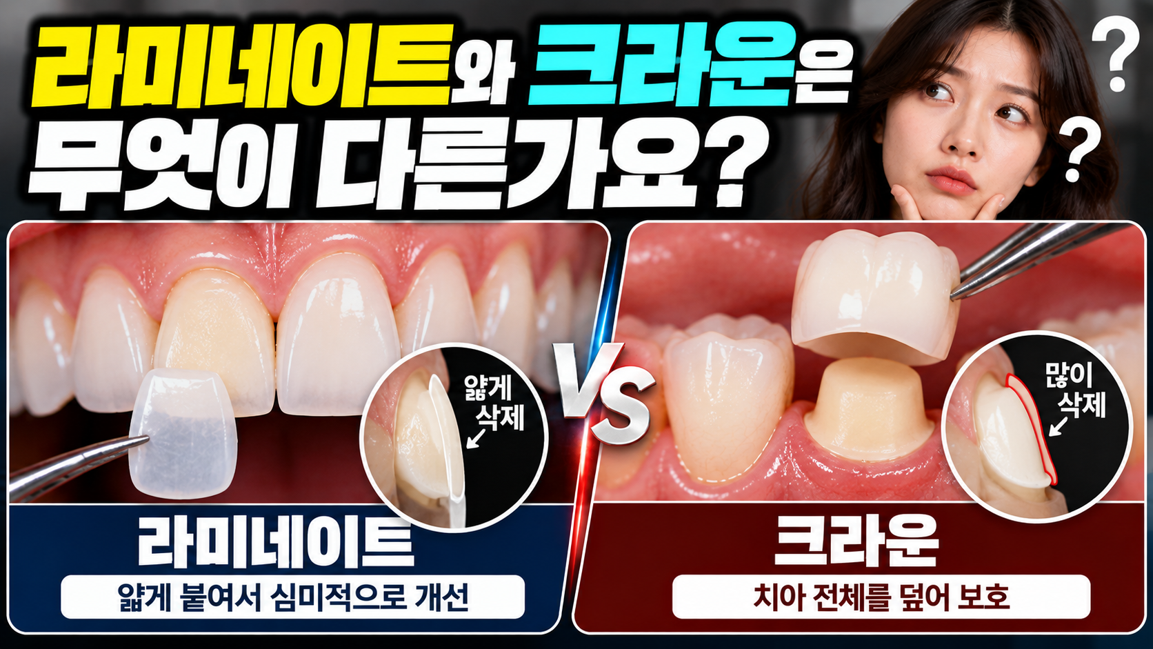 라미네이트와 크라운은 무엇이 다른가요?