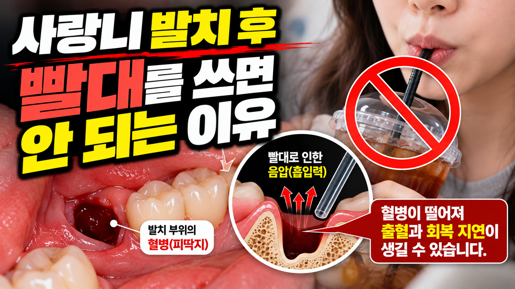 사랑니 발치 후 빨대를 쓰면 안 되는 이유
