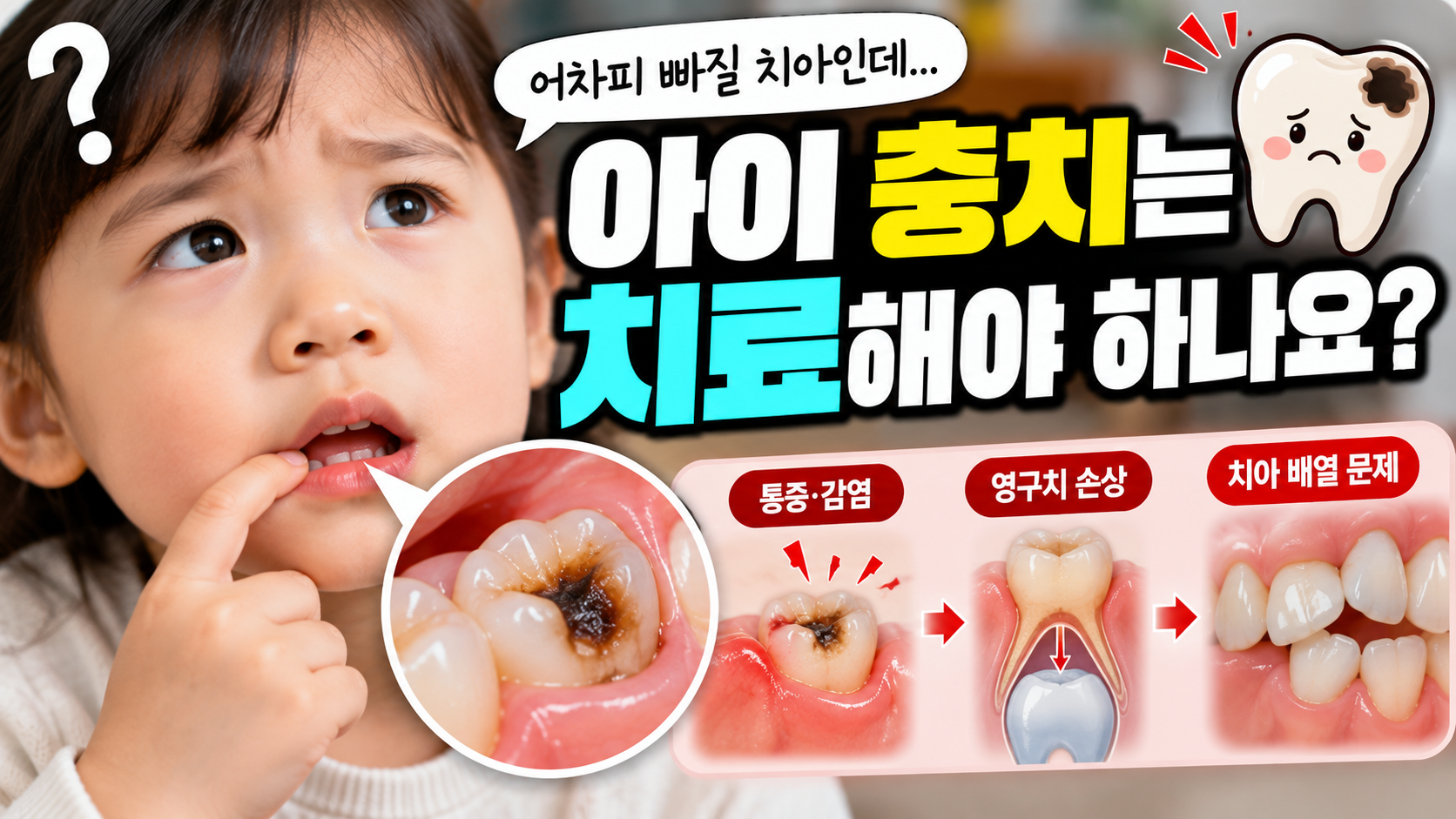 아이 충치는 어차피 빠질 치아인데 치료해야 하나요?