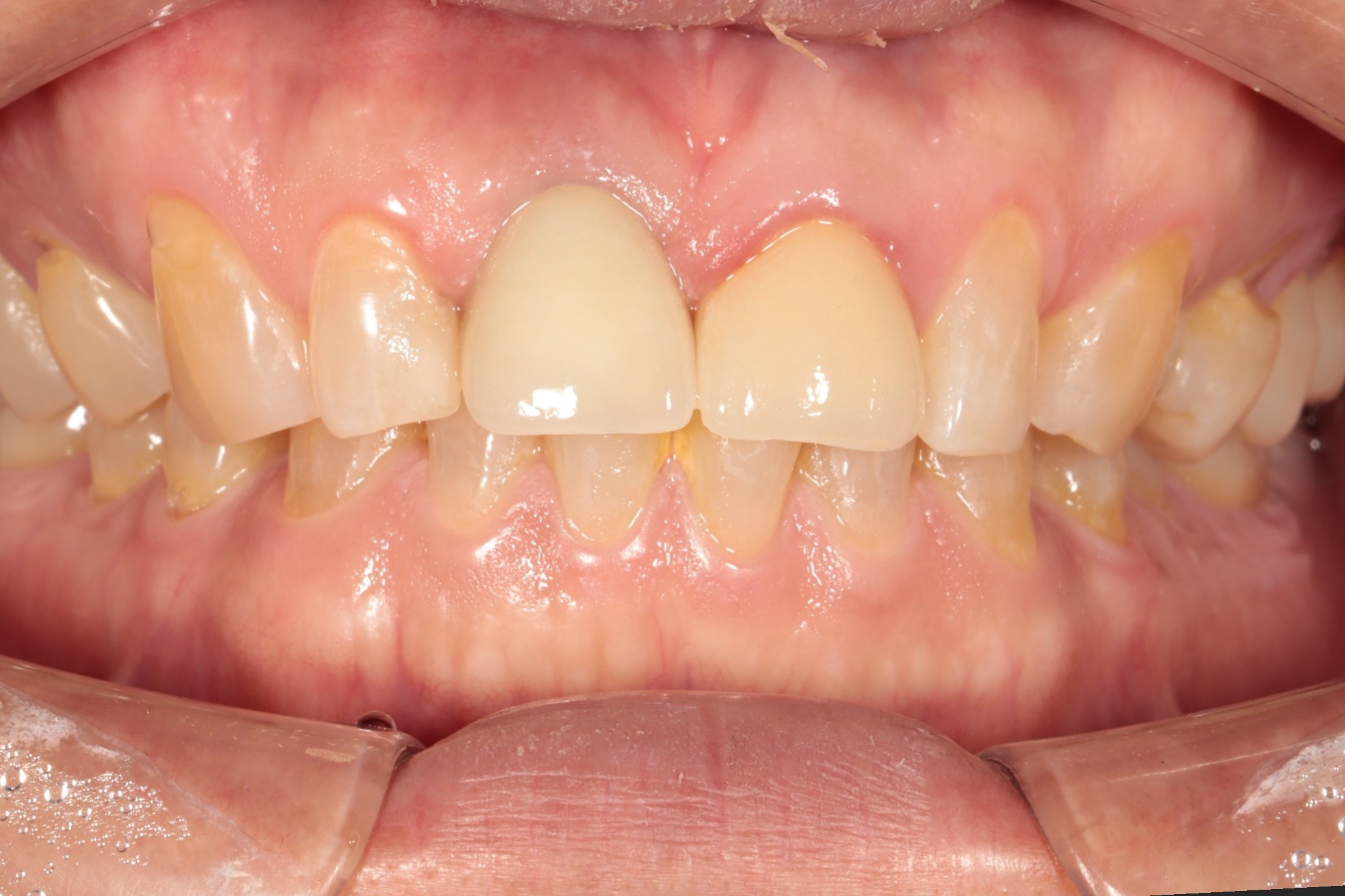“앞니가 흔들리는데 어떻게 치료해야하나요?"