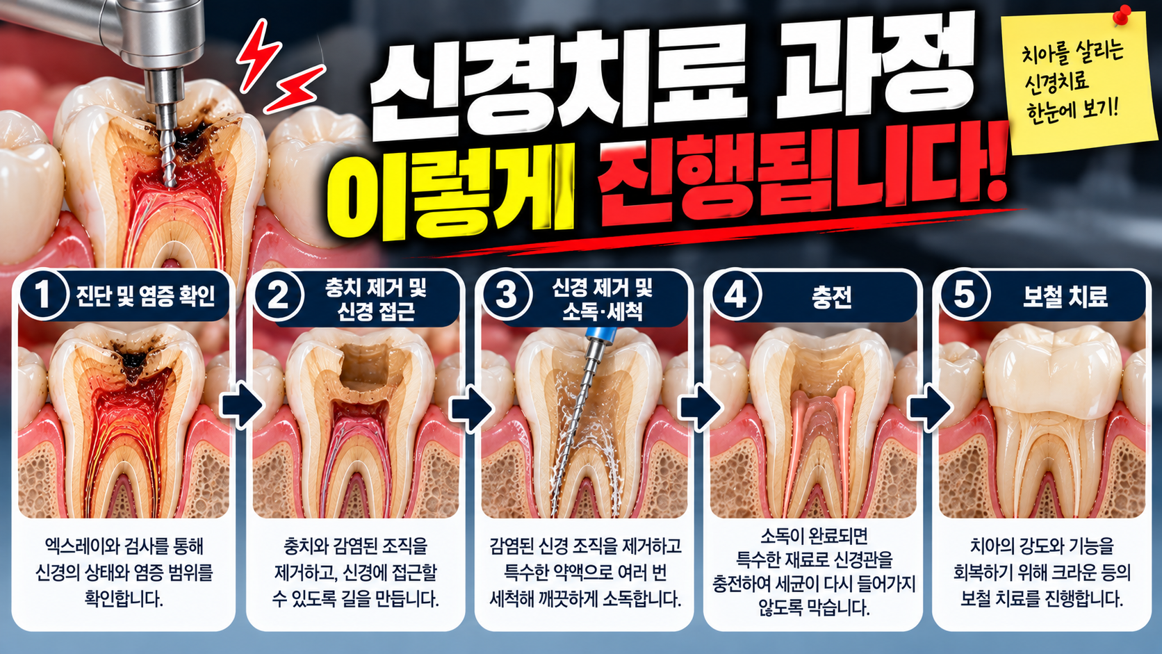 신경치료는 왜 한 번에 끝나지 않을까요? — 본문 이미지 1