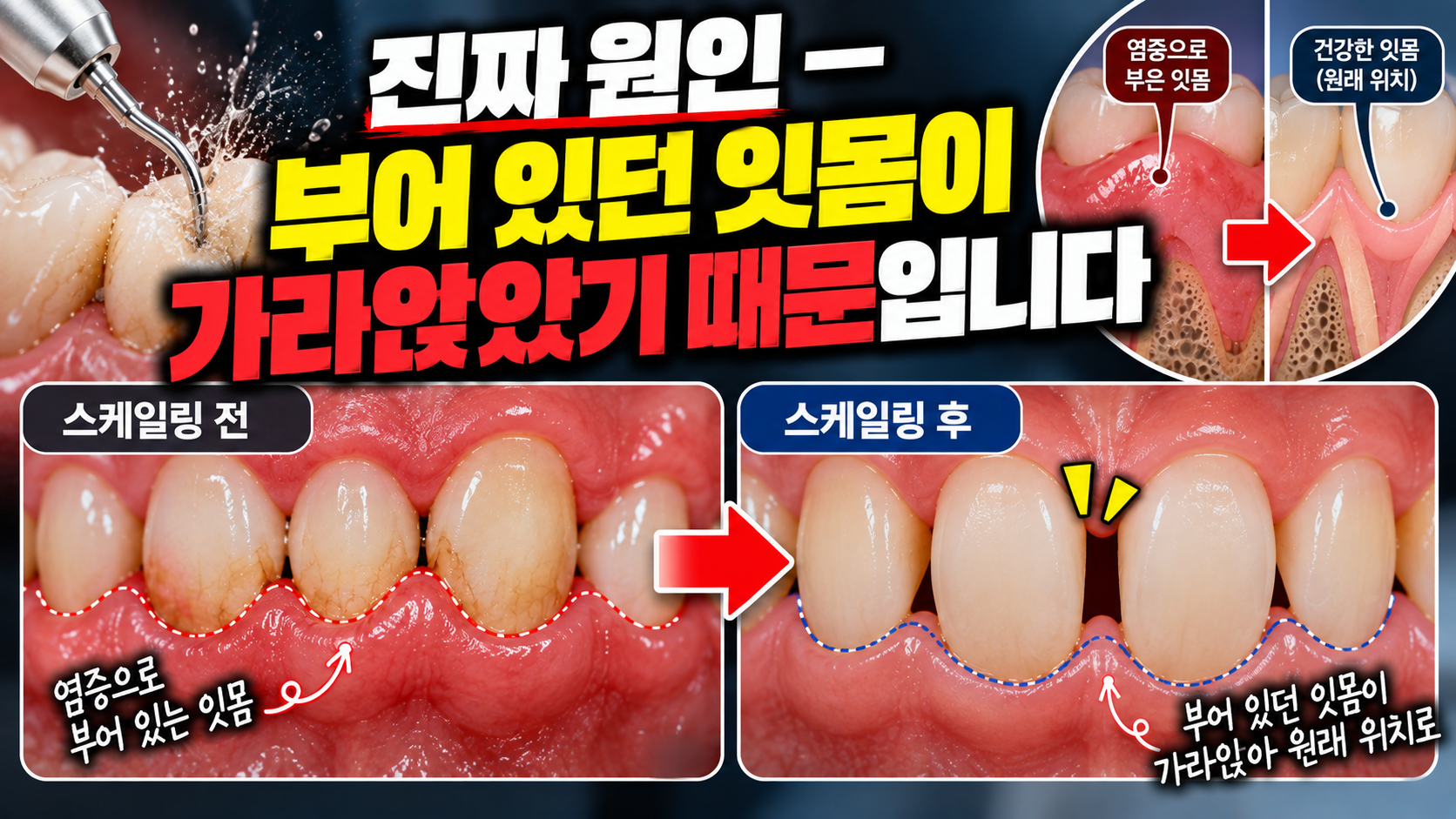스케일링 후 치아 사이가 벌어진 것 같은 이유 — 본문 이미지 1