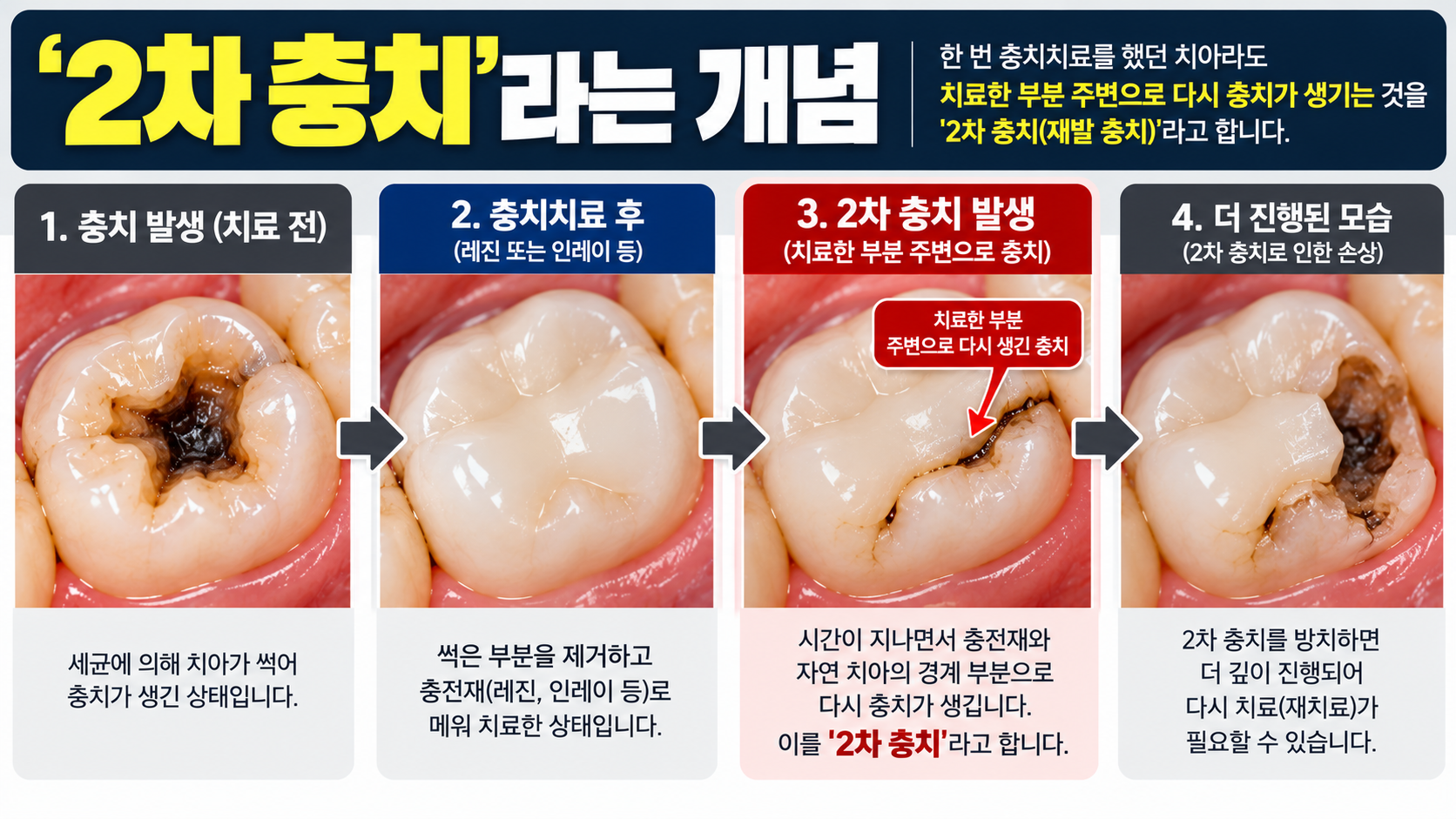 충치치료한 치아가 다시 썩을 수도 있나요? — 본문 이미지 1