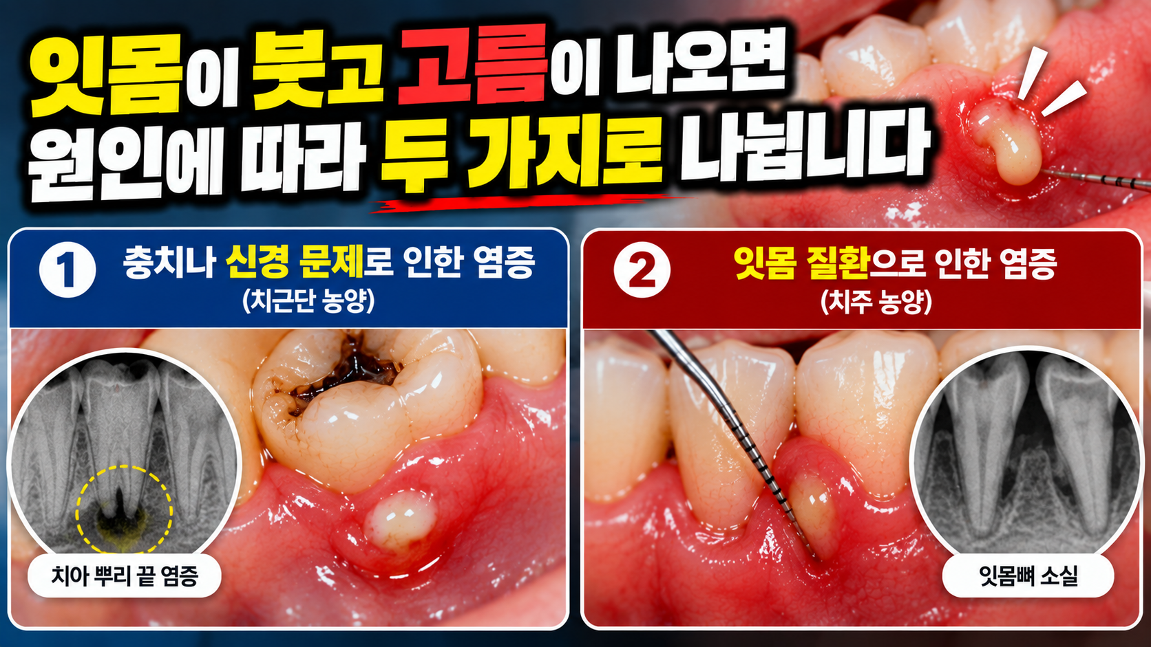 잇몸이 붓고 고름이 나오면 어떤 문제일까요? — 본문 이미지 1