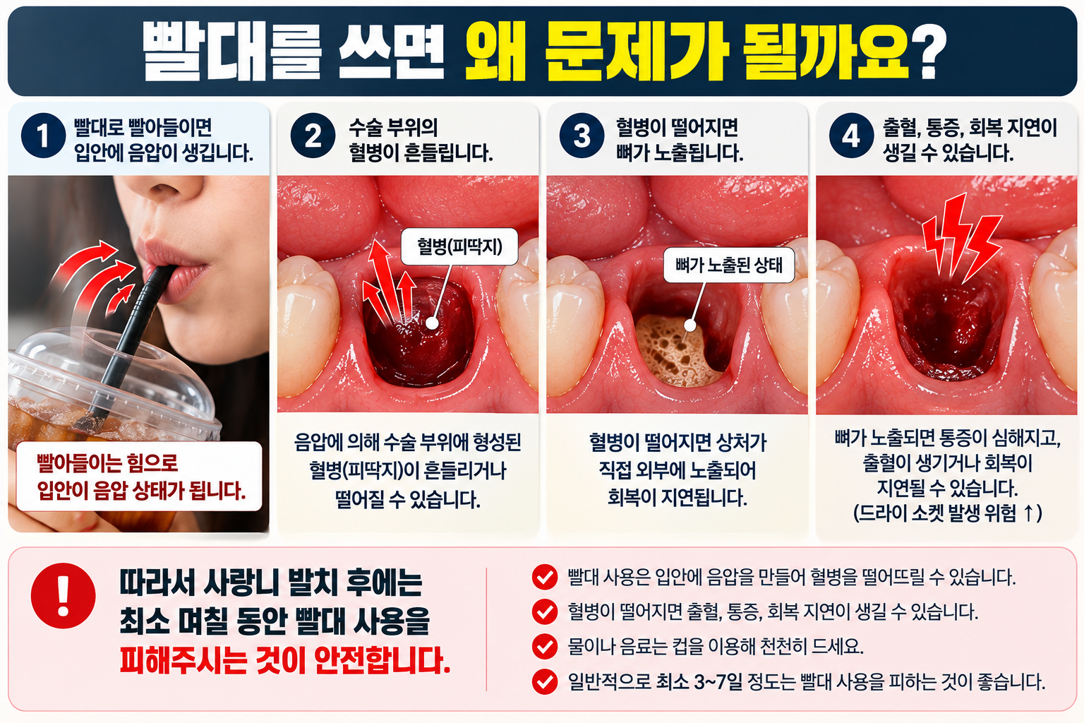 사랑니 발치 후 빨대를 쓰면 안 되는 이유 — 본문 이미지 1
