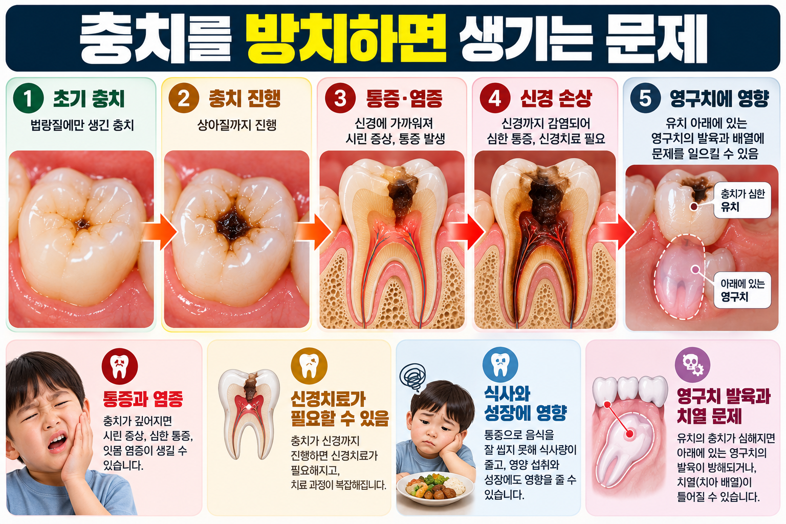 아이 충치는 어차피 빠질 치아인데 치료해야 하나요? — 본문 이미지 1